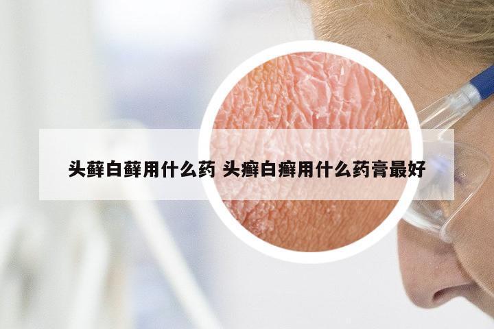 头藓白藓用什么药 头癣白癣用什么药膏最好