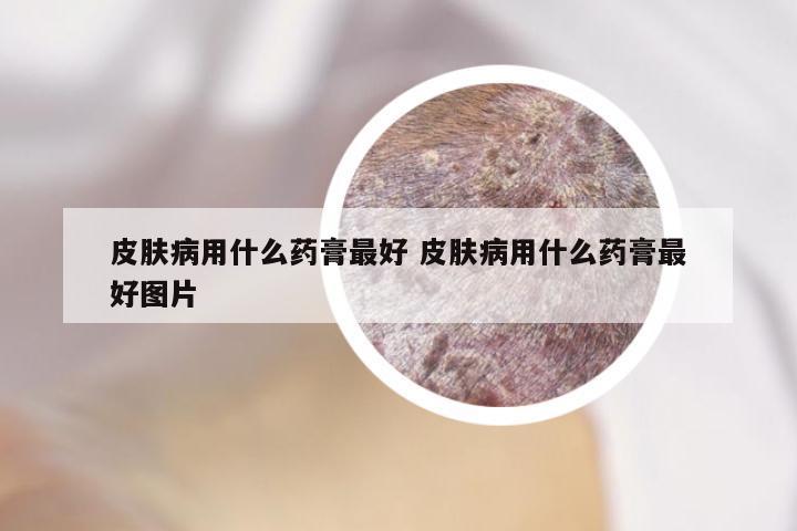 皮肤病用什么药膏最好 皮肤病用什么药膏最好图片