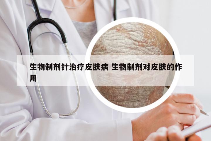 生物制剂针治疗皮肤病 生物制剂对皮肤的作用