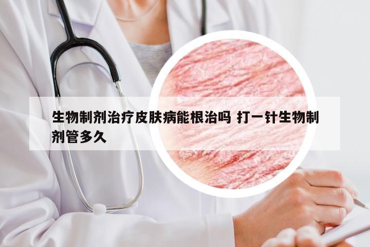 生物制剂治疗皮肤病能根治吗 打一针生物制剂管多久