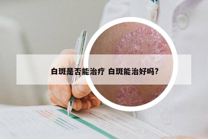 白斑是否能治疗 白斑能治好吗?