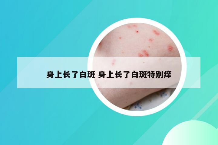 身上长了白斑 身上长了白斑特别痒