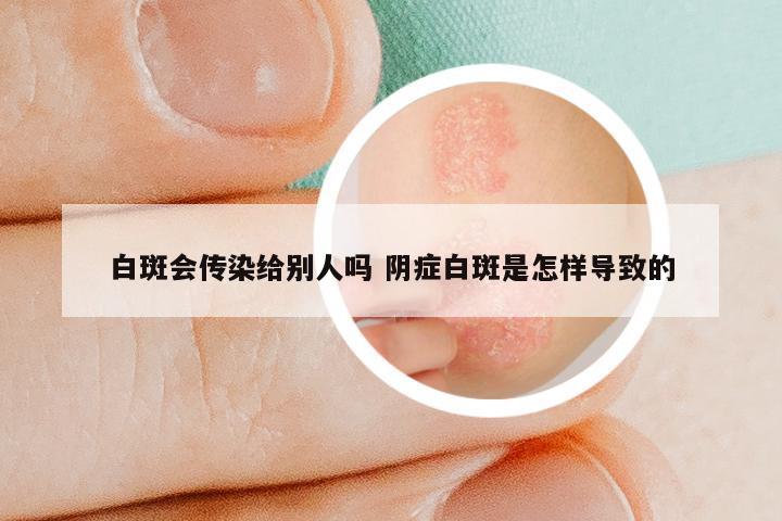 白斑会传染给别人吗 阴症白斑是怎样导致的