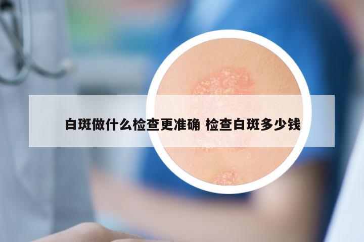 白斑做什么检查更准确 检查白斑多少钱