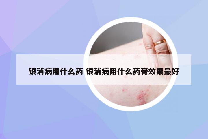 银消病用什么药 银消病用什么药膏效果最好