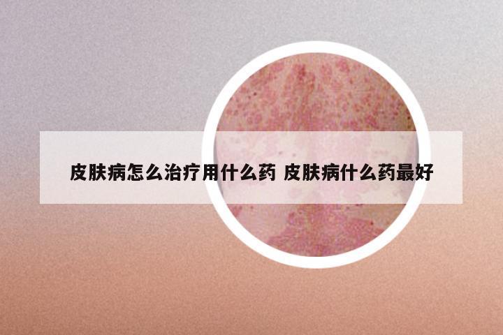 皮肤病怎么治疗用什么药 皮肤病什么药最好