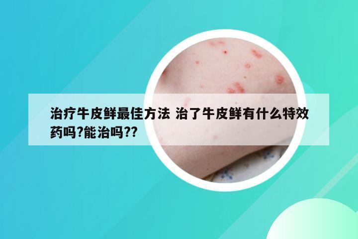 治疗牛皮鲜最佳方法 治了牛皮鲜有什么特效药吗?能治吗??