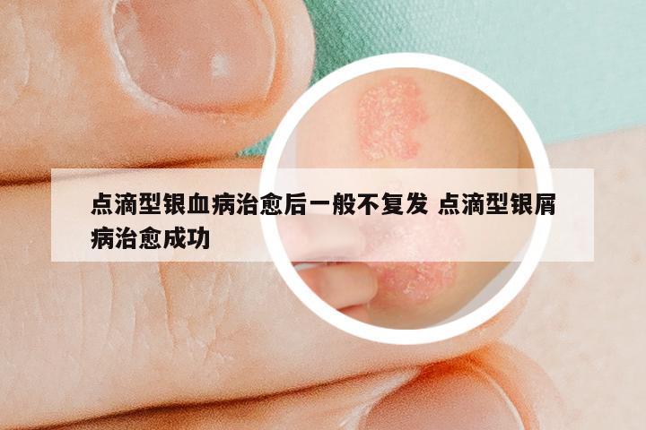 点滴型银血病治愈后一般不复发 点滴型银屑病治愈成功