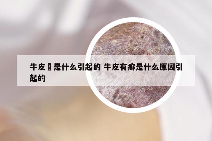 牛皮癬是什么引起的 牛皮有癣是什么原因引起的