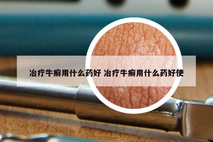 冶疗牛癣用什么药好 冶疗牛癣用什么药好使