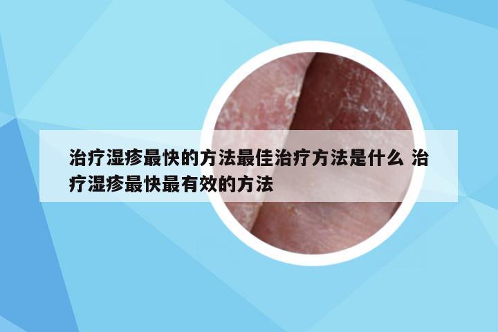 治疗湿疹最快的方法最佳治疗方法是什么 治疗湿疹最快最有效的方法