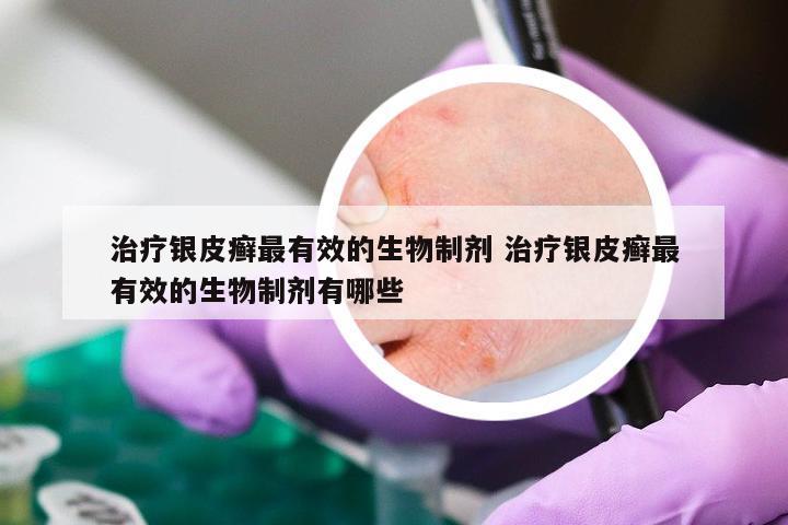 治疗银皮癣最有效的生物制剂 治疗银皮癣最有效的生物制剂有哪些