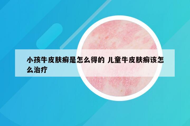 小孩牛皮肤癣是怎么得的 儿童牛皮肤癣该怎么治疗