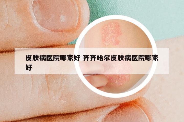 皮肤病医院哪家好 齐齐哈尔皮肤病医院哪家好