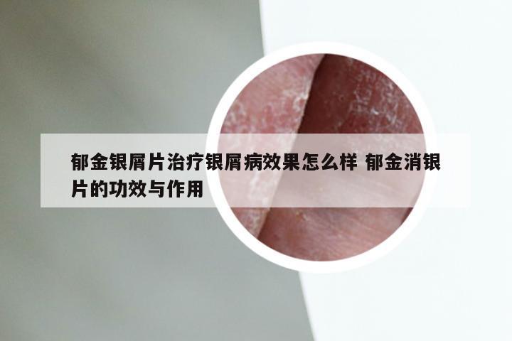 郁金银屑片治疗银屑病效果怎么样 郁金消银片的功效与作用