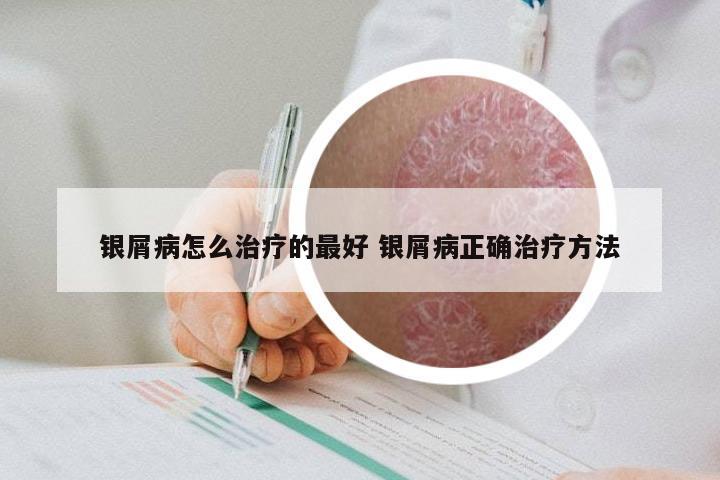 银屑病怎么治疗的最好 银屑病正确治疗方法