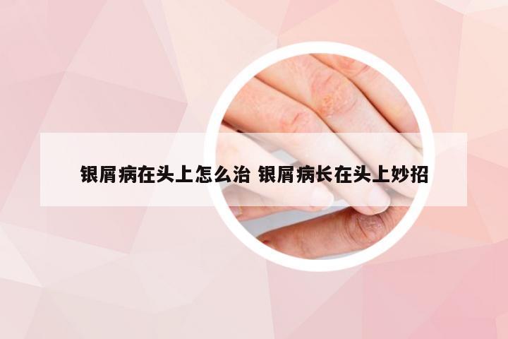 银屑病在头上怎么治 银屑病长在头上妙招