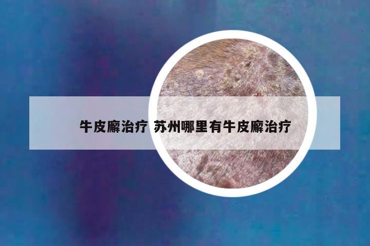 牛皮廨治疗 苏州哪里有牛皮廨治疗