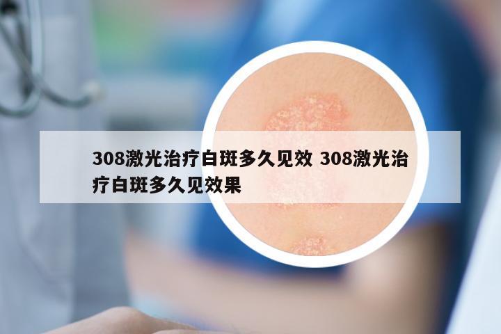 308激光治疗白斑多久见效 308激光治疗白斑多久见效果