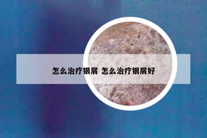 怎么治疗银屑 怎么治疗银屑好