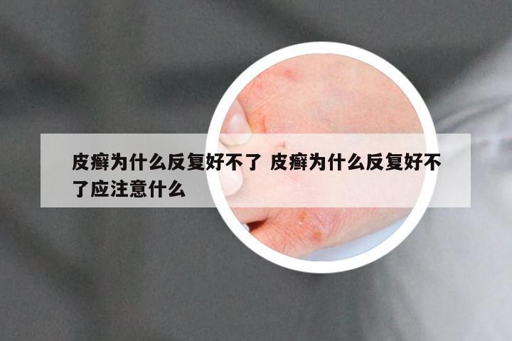 皮癣为什么反复好不了 皮癣为什么反复好不了应注意什么