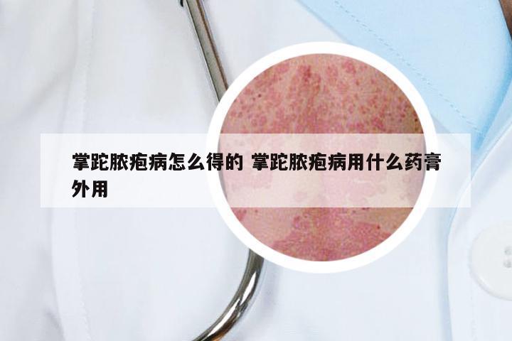 掌跎脓疱病怎么得的 掌跎脓疱病用什么药膏外用