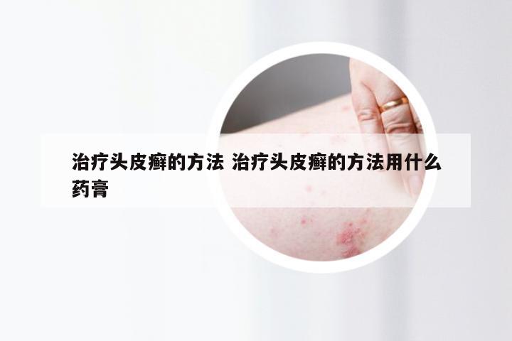 治疗头皮癣的方法 治疗头皮癣的方法用什么药膏