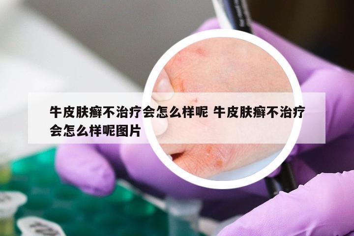 牛皮肤癣不治疗会怎么样呢 牛皮肤癣不治疗会怎么样呢图片