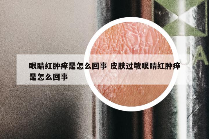 眼睛红肿痒是怎么回事 皮肤过敏眼睛红肿痒是怎么回事