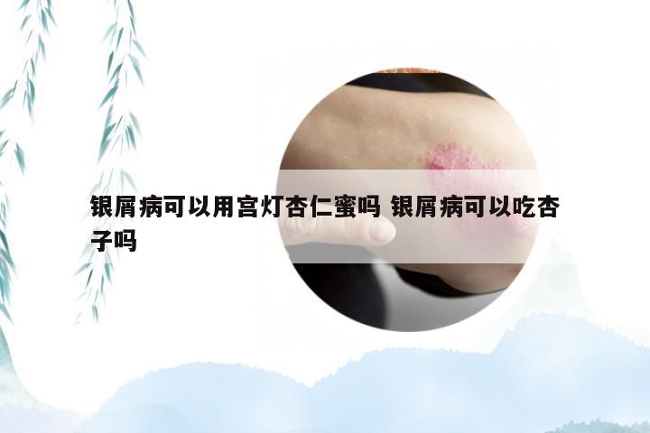 银屑病可以用宫灯杏仁蜜吗 银屑病可以吃杏子吗