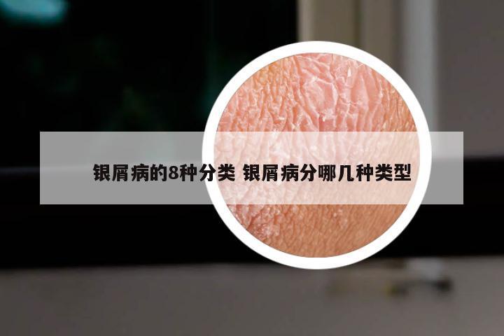 银屑病的8种分类 银屑病分哪几种类型