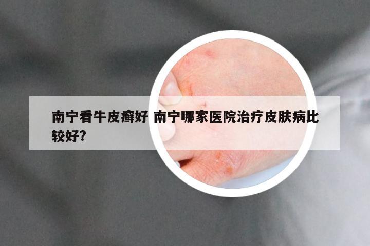 南宁看牛皮癣好 南宁哪家医院治疗皮肤病比较好?