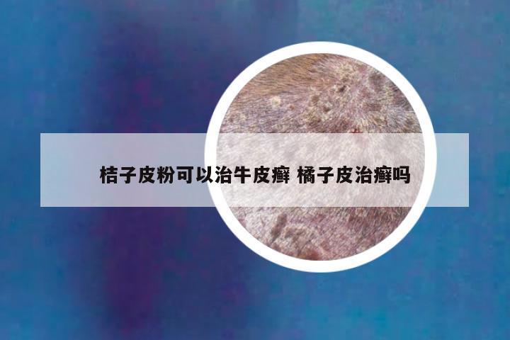 桔子皮粉可以治牛皮癣 橘子皮治癣吗