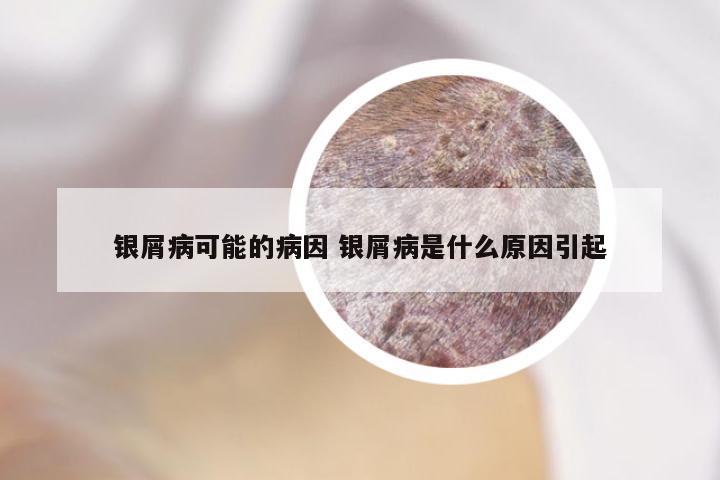 银屑病可能的病因 银屑病是什么原因引起