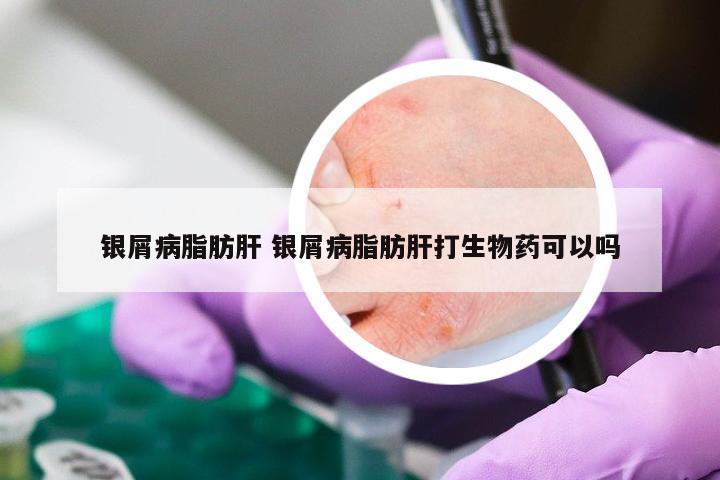 银屑病脂肪肝 银屑病脂肪肝打生物药可以吗