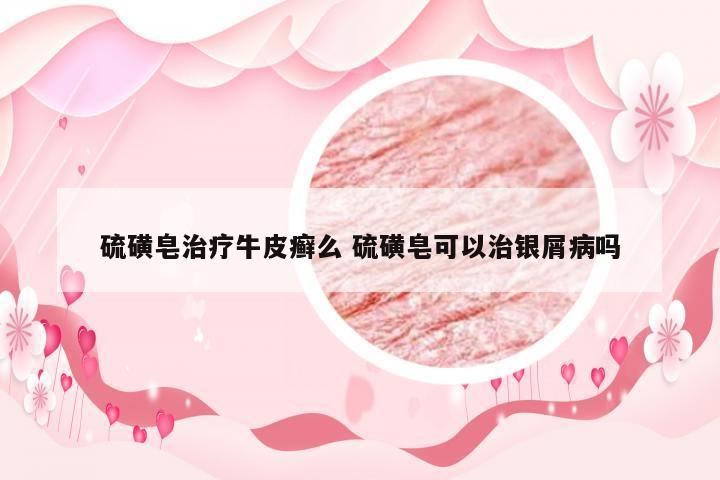 硫磺皂治疗牛皮癣么 硫磺皂可以治银屑病吗