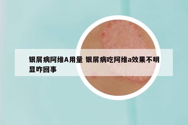 银屑病阿维A用量 银屑病吃阿维a效果不明显咋回事