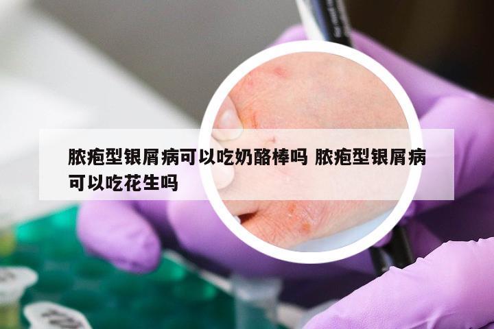 脓疱型银屑病可以吃奶酪棒吗 脓疱型银屑病可以吃花生吗