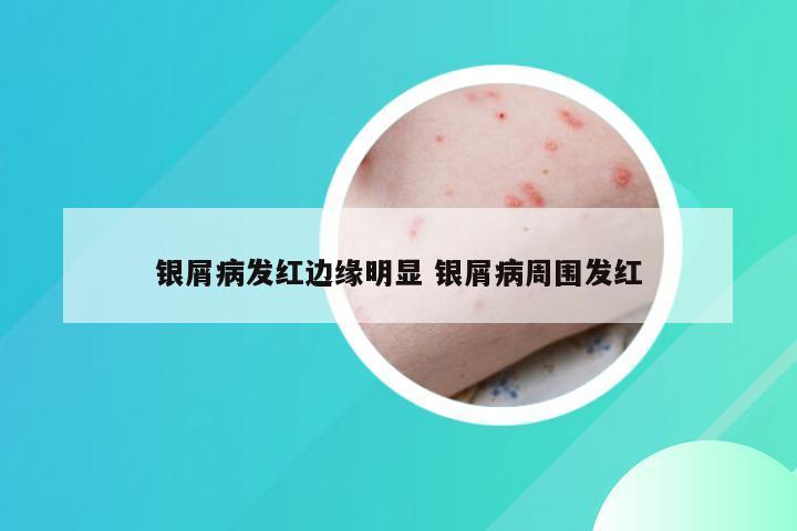 银屑病发红边缘明显 银屑病周围发红