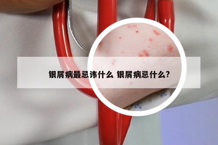 银屑病最忌讳什么 银屑病忌什么?