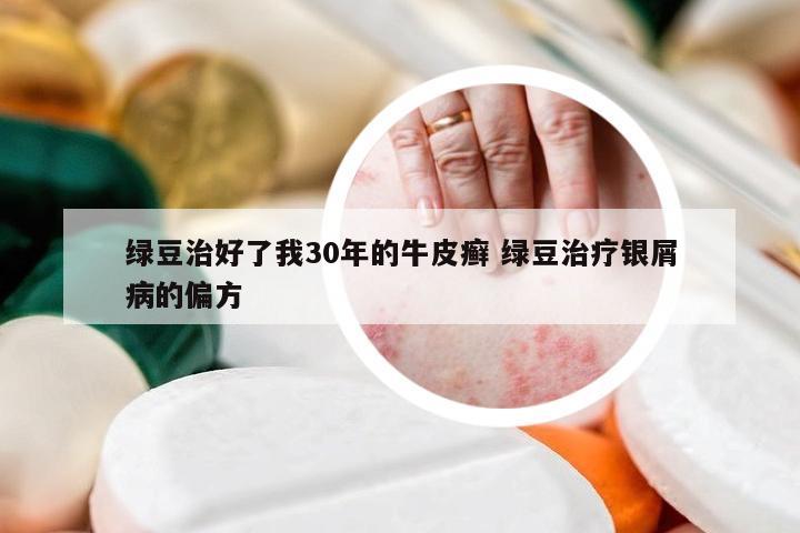 绿豆治好了我30年的牛皮癣 绿豆治疗银屑病的偏方