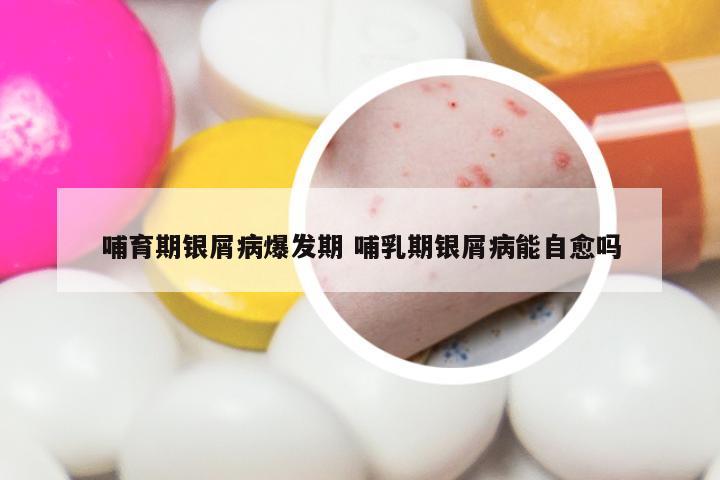 哺育期银屑病爆发期 哺乳期银屑病能自愈吗