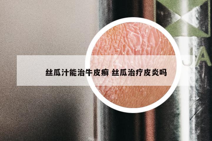 丝瓜汁能治牛皮癣 丝瓜治疗皮炎吗