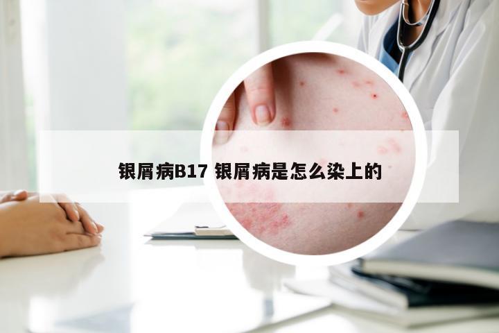 银屑病B17 银屑病是怎么染上的