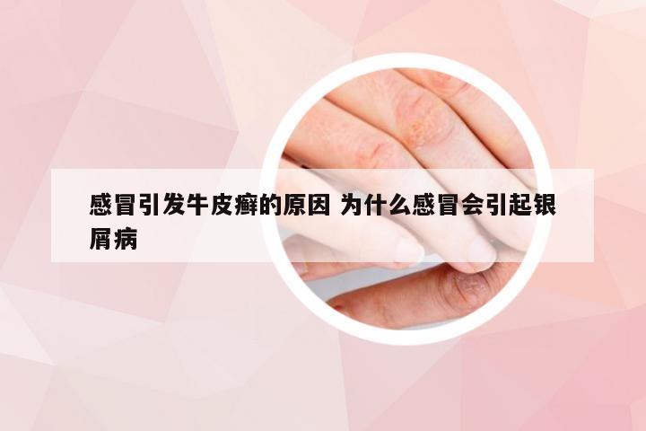 感冒引发牛皮癣的原因 为什么感冒会引起银屑病