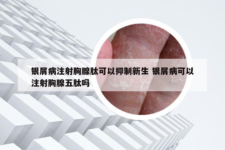 银屑病注射胸腺肽可以抑制新生 银屑病可以注射胸腺五肽吗