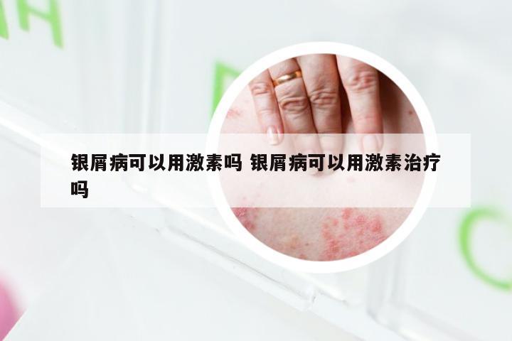 银屑病可以用激素吗 银屑病可以用激素治疗吗