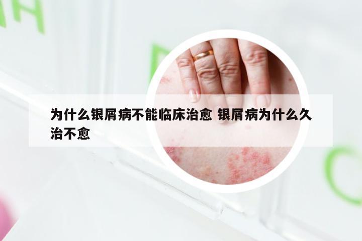 为什么银屑病不能临床治愈 银屑病为什么久治不愈