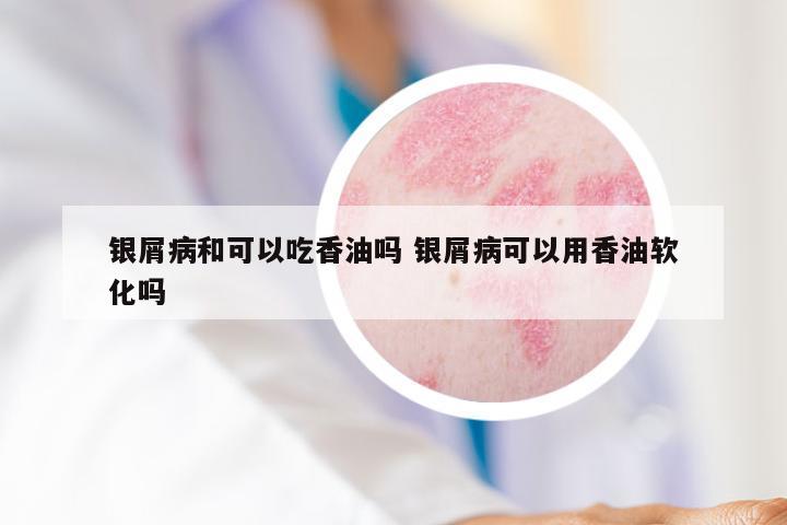 银屑病和可以吃香油吗 银屑病可以用香油软化吗