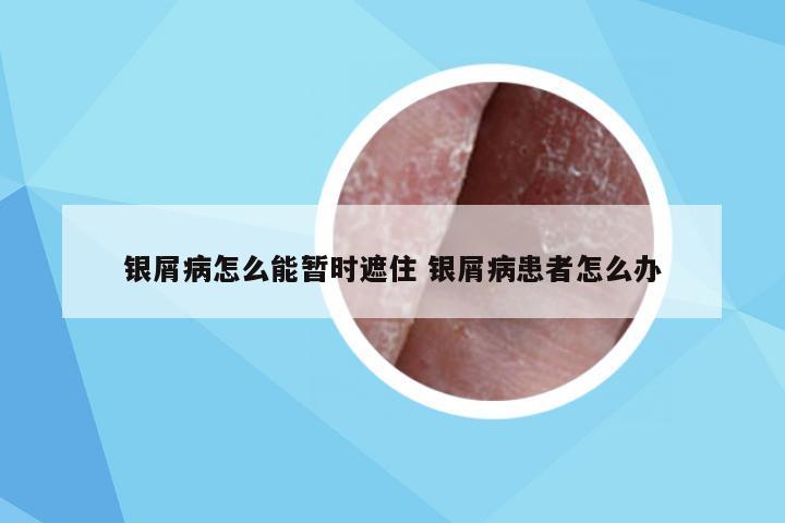 银屑病怎么能暂时遮住 银屑病患者怎么办